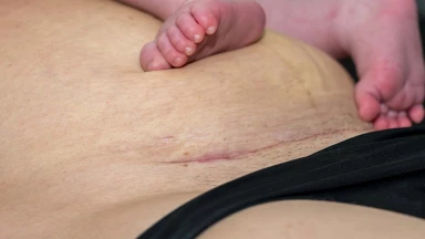 Closeup of the feet of a baby lying on its mother’s stomach, which shows the scars from a cesarean section, representing the potential grounds for a birth injury lawsuit.