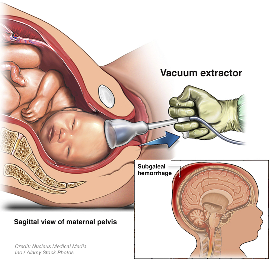 Birth Trauma - Vacuum Extractor