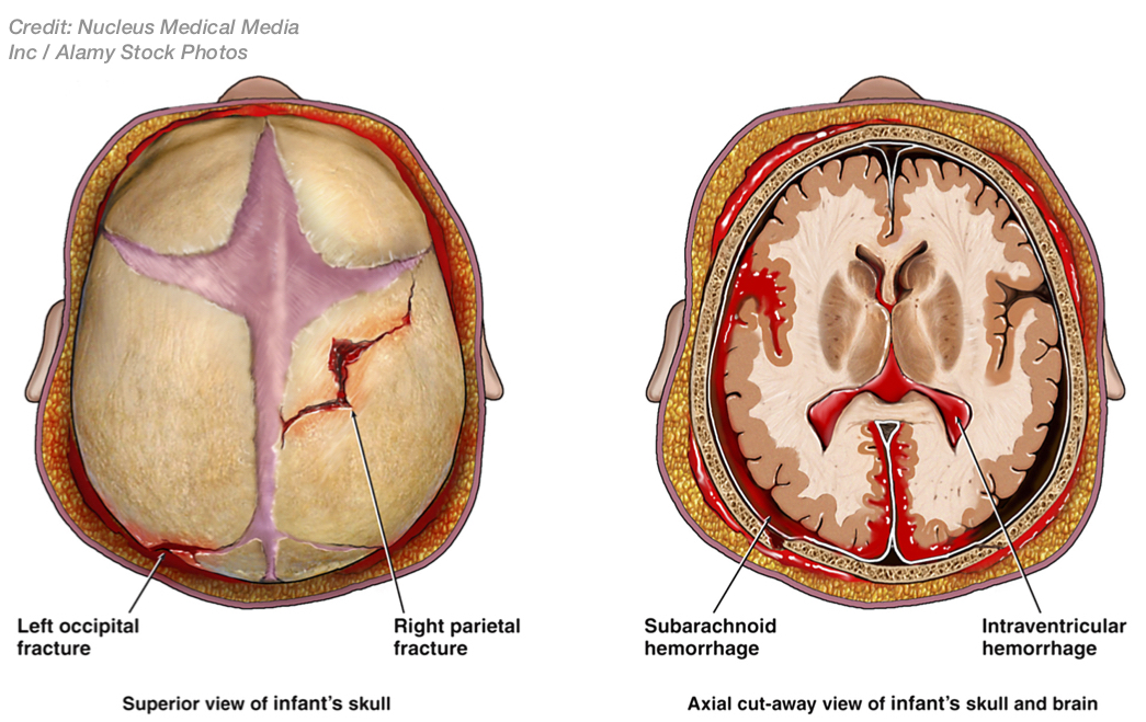 Birth Injury - Skull fractures