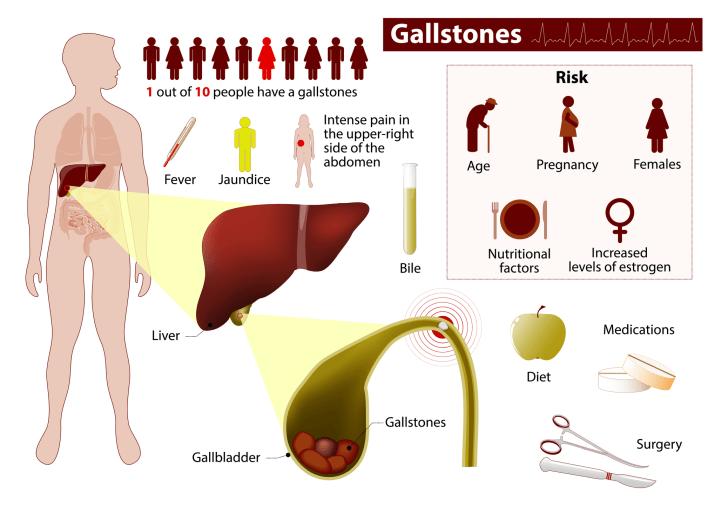 Gallstone Facts