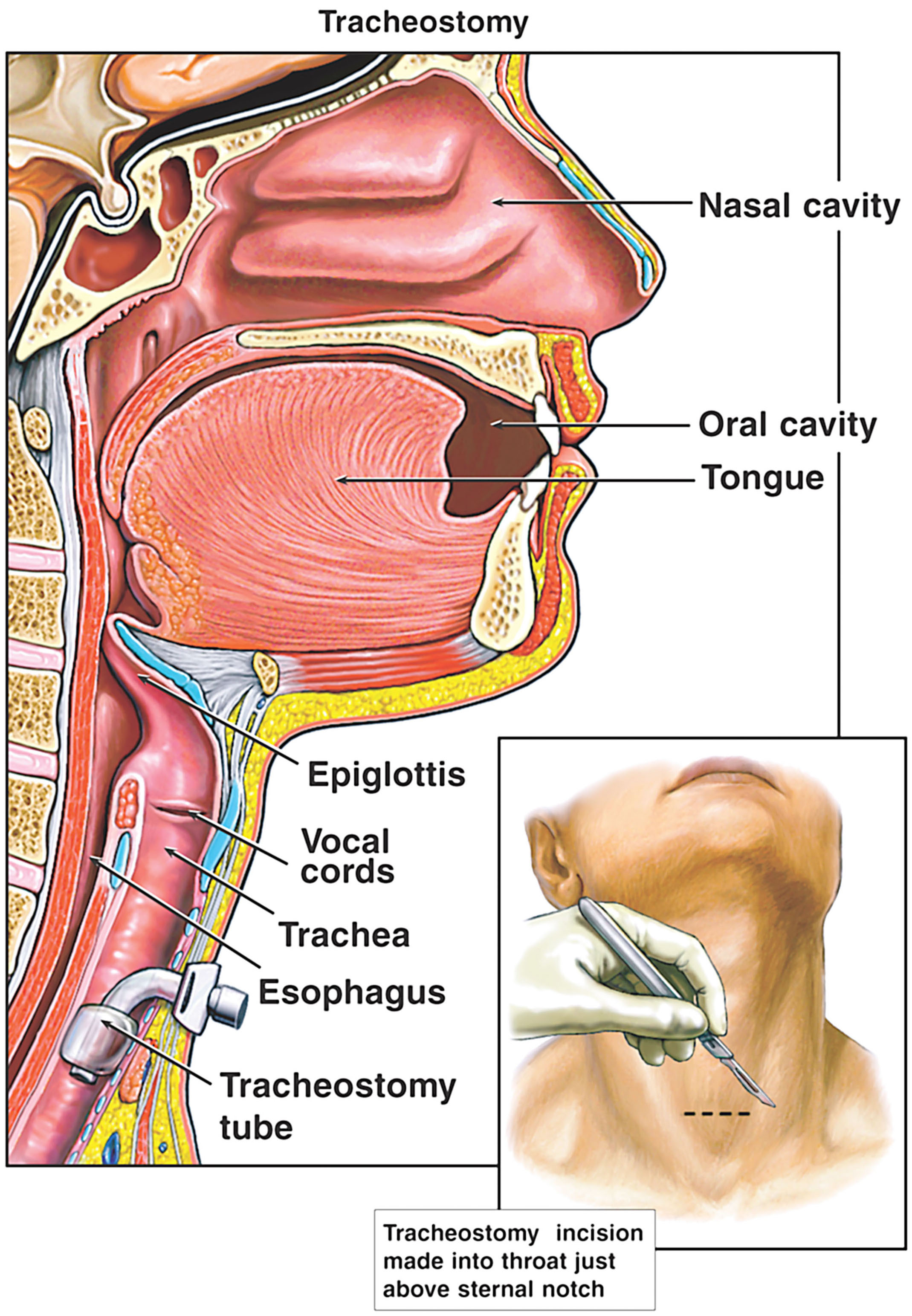 Tracheostomy.jpg