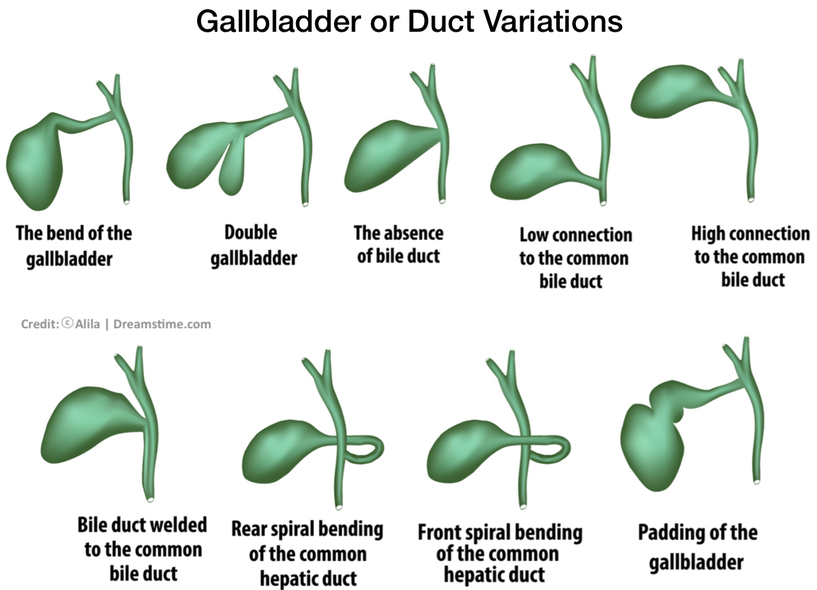 Gallbladder or Duct Variations