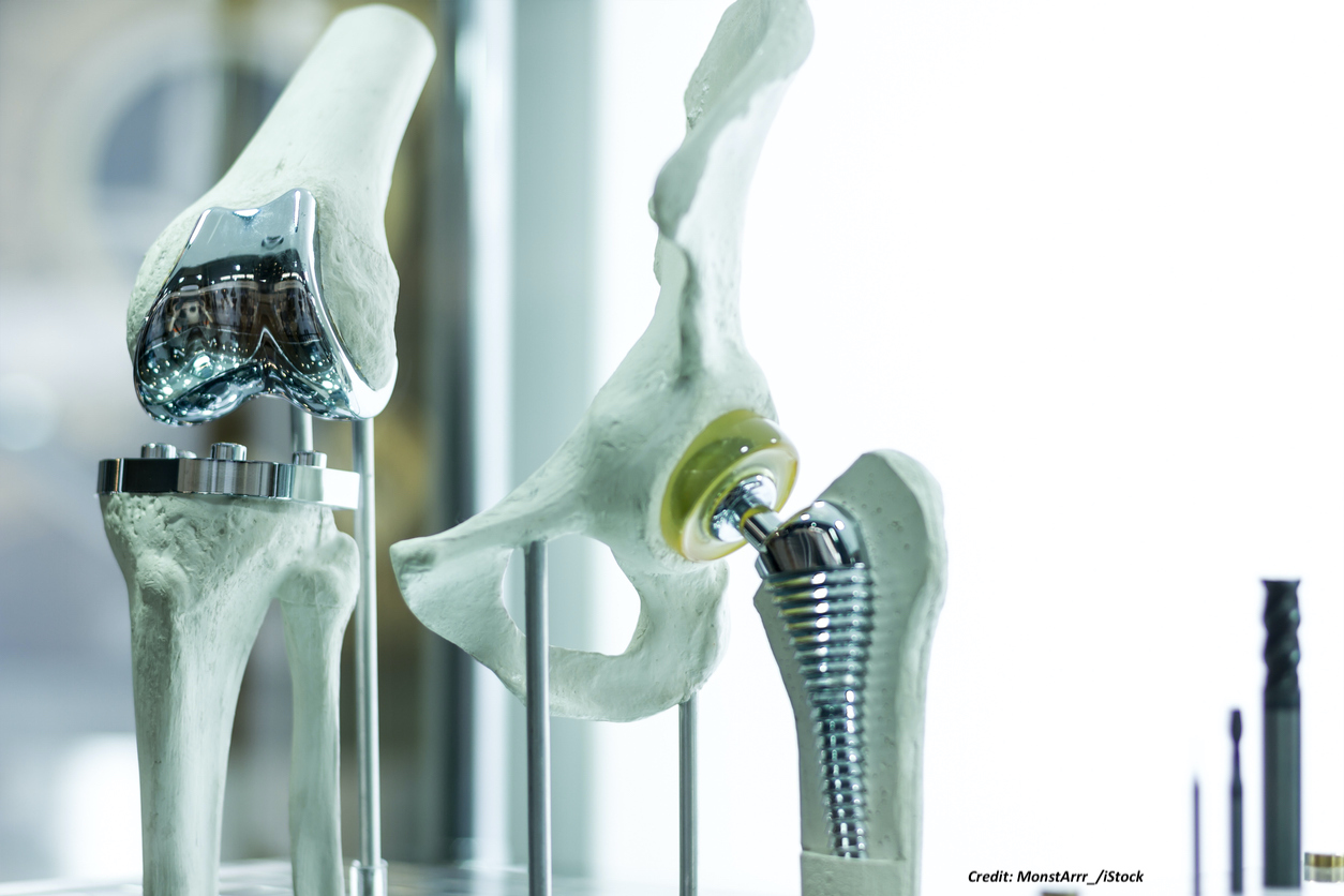 hipknee-implants.jpg