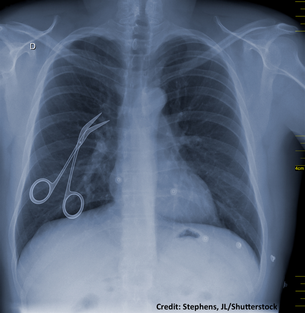 X-ray of the chest