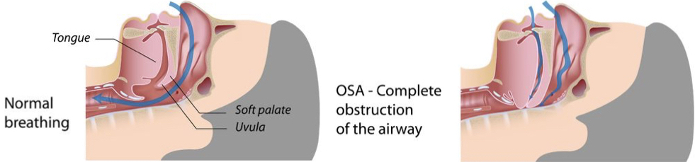 Illustration showing complete obstruction of airway